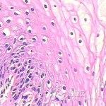 virus,缩写:hpv)感染引起的好发于外阴及肛门的性传播疾病;主要由hpv6