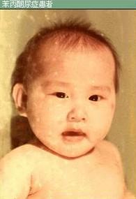 苯丙酮尿症