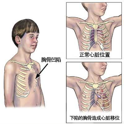 x线剖位胸片可见下段胸骨向后凹陷,与脊柱间的距离缩短.