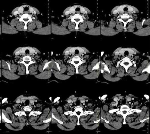 双侧甲状腺肿大   ct病例