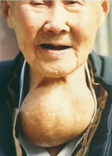 肿块生长速度:地方性甲状腺肿增长缓慢,病程长达数年之久;良性肿瘤