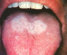 舌扁平苔藓(lichen planus)是一种皮肤粘膜慢性炎性