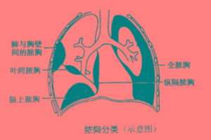 【脓胸