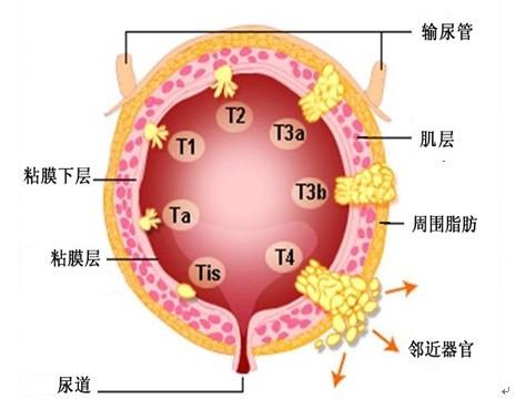 膀胱癌 - 搜搜百科