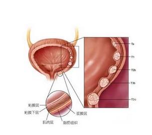 膀胱癌