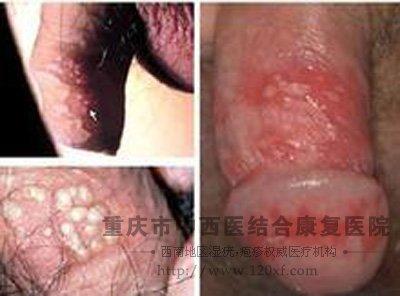 包皮湿疣
