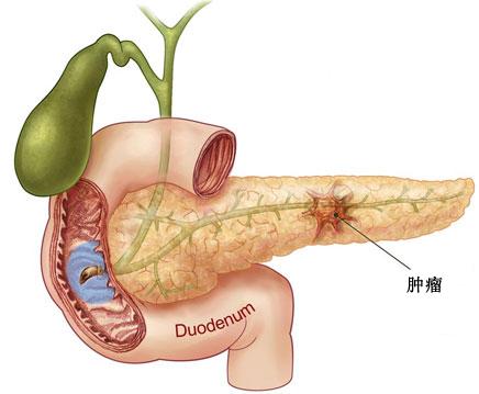 胰腺囊肿