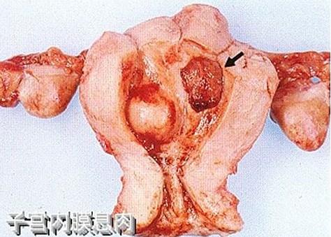 子宫内膜息肉
