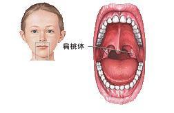 舌扁桃体肥大图片高清