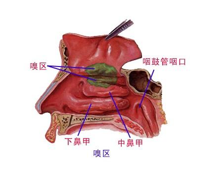 鼻咽癌的远处转移