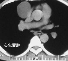 请问心包囊肿要紧吗?要开刀的话,在上海哪一家医院比较好?