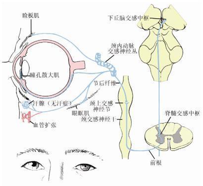 动眼神经麻痹