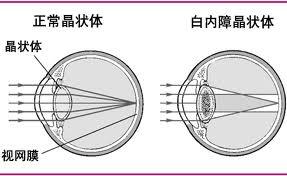 眼睛的类型视频 bki-20130826145716-1558145839.jpg