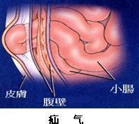 直疝的发病率远较斜疝为少,占腹股沟疝的4.2%.