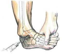 足跟骨刺图片骨刺图片 脚后跟骨刺图片1; 踝护脚腕脚腕疼痛跟骨刺