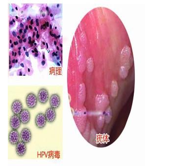 由于引起尖锐湿疣的某些hpv亚型与<em>生殖器</em>癌
