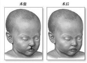 唇裂