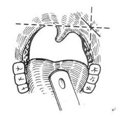 扁桃体周围脓肿+-+搜搜百科
