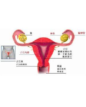 子宫息肉