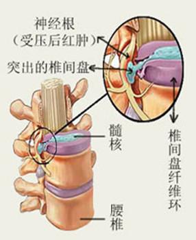 椎间盘脱出