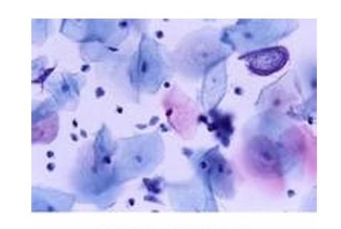 男性滴虫病常感染前列腺和尿道