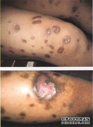 艾滋病症状图片四:皮肤脓疱疹;; 脓疱疹
