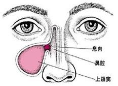 副鼻窦炎