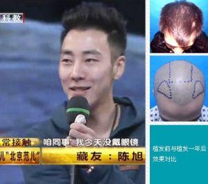 陈旭无痕<em>加密</em>植发