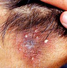 历史版本  毛囊炎是指葡萄球菌侵入毛囊部位所发生的化脓性炎症