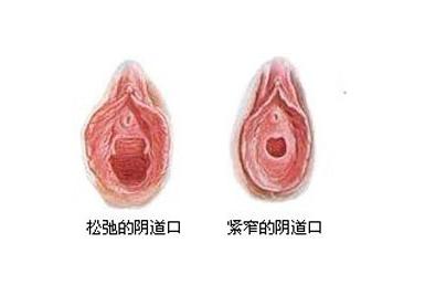 产后<em>女性</em>或者已经出现<em>阴道</em>松弛的<em>女性</em>该<em>如何</em>进