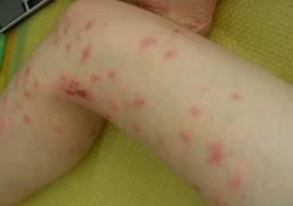 虫咬性皮炎又可称"丘疹性荨麻疹",主要与节肢动物的叮咬有关,常见的如