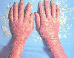 皮肤表现为表皮全层坏死及表皮下大疱形成