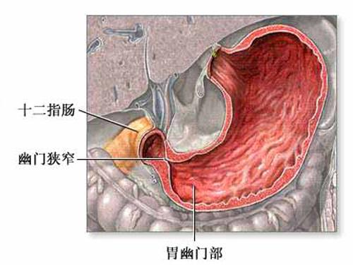 药物性胃病; 幽门狭窄扩张术
