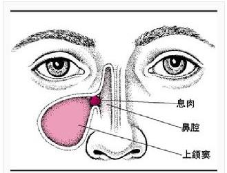 单侧鼻腔阻塞