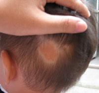 儿童期,表皮除轻度增生外,可见小的分化不完全的毛囊结构,而皮脂腺