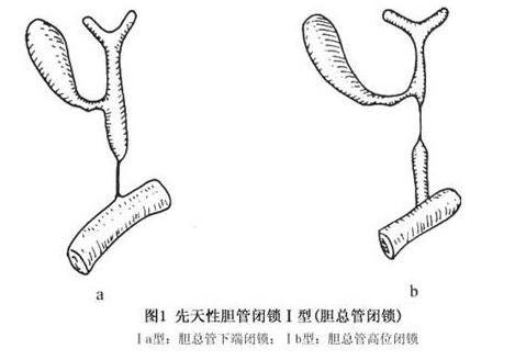 全部版本 历史版本  先天性胆道闭锁有多种分型方法,根据胆管闭锁的