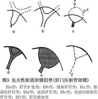 胆道闭锁