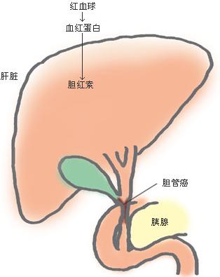 胆道梗阻