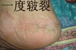 手足皲裂