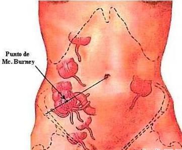 <em>阑尾炎</em>穿孔-+搜搜百科