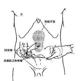 阑尾炎穿孔 - 搜狗百科; 阑尾与盲肠位置图
