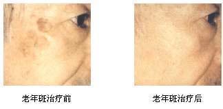 老年斑