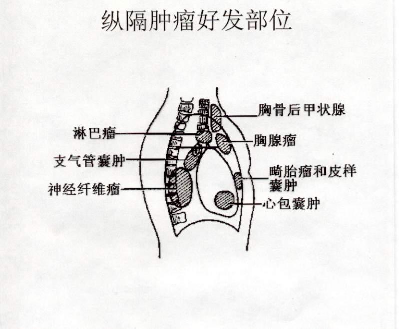 纵隔气管支气管囊肿依其所在部位可分为气管旁,隆突周围,肺门旁,食管