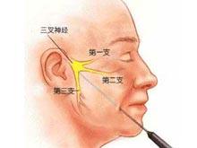 三叉神经分布区麻木感