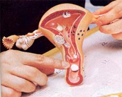 它是指尿道黏膜及黏膜下组织脱出并外翻于外的一种女性尿道疾病