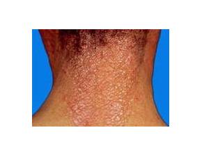 皮肤一块一块粗糙图片