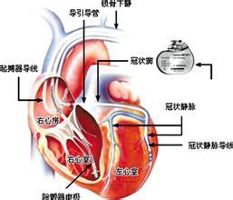 起搏器