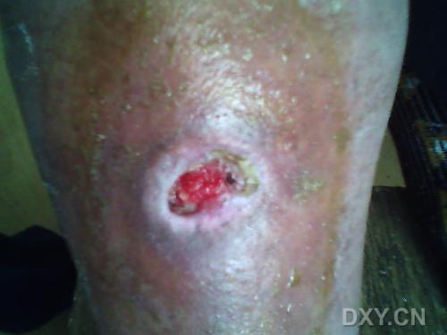 皮肤和软组织感染+-+搜搜百科