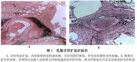 乳腺导管扩张