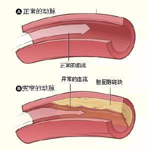 动脉血管硬化变脆